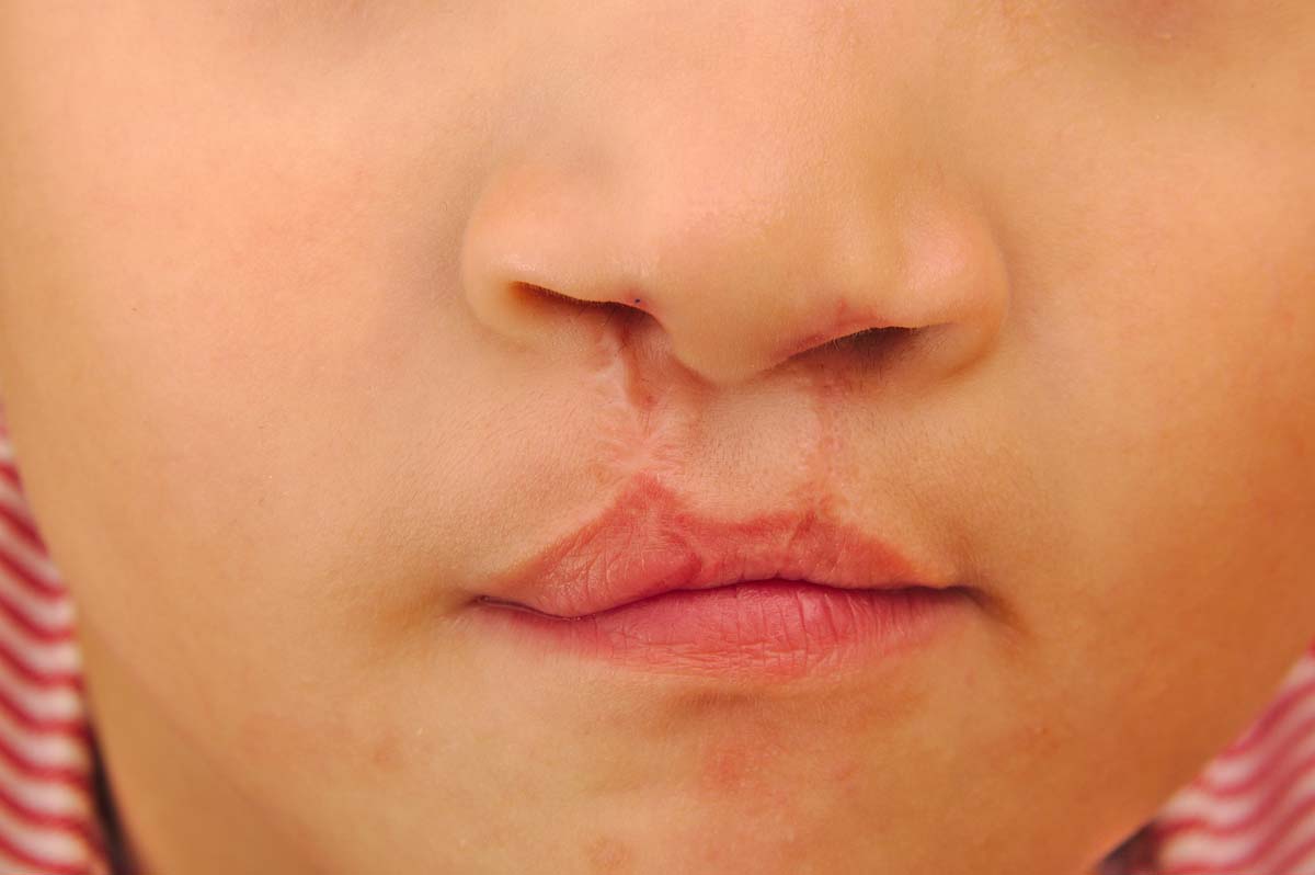 Boy showing a bilateral cleft lip repaired - Diario Puerto Varas