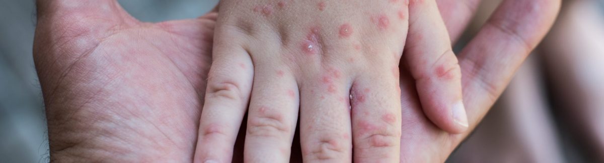 Viruela del mono pone en alerta a autoridades sanitarias